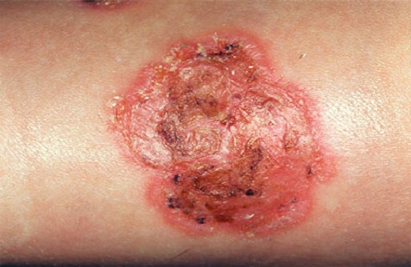 Viêm da dị ứng bội nhiễm là giai đoạn tiến triển phức tạp và nghiêm trọng của viêm da dị ứng.