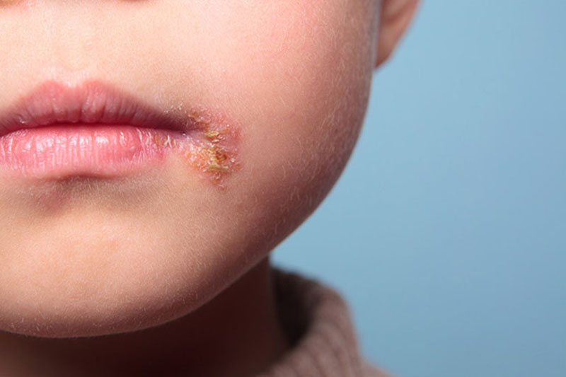 Viêm da liên cầu ở trẻ em xuất hiện ở vùng kẽ mép, hai bên kẽ quanh miệng