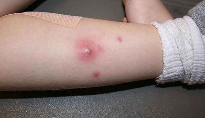 Viêm da mủ là dạng viêm da do tạp khuẩn gây viêm nhiễm trên da