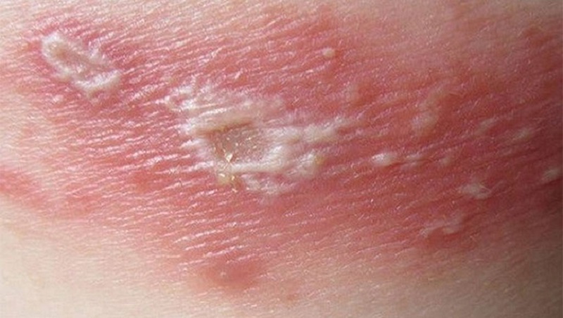 Viêm da mủ là tình trạng vi khuẩn tấn công các lỗ chân lông