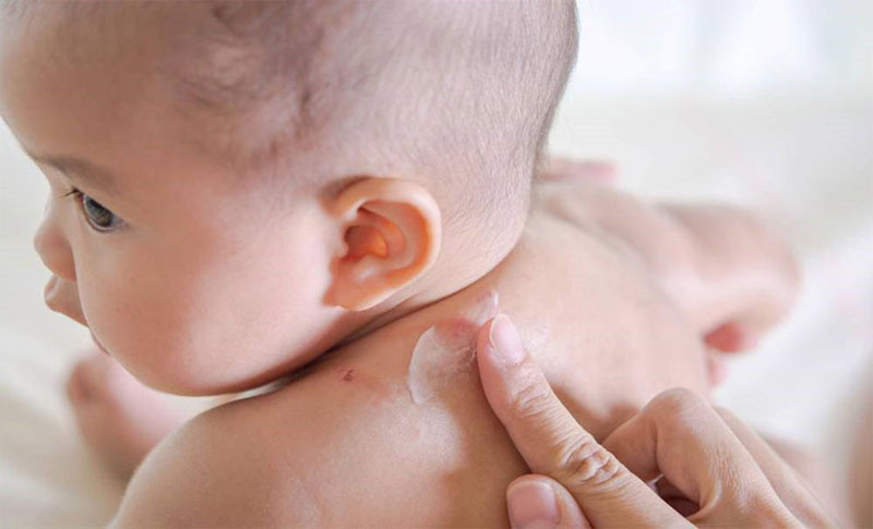 Điều trị cho trẻ sơ sinh thường được kê các loại thuốc bôi ngoài da 