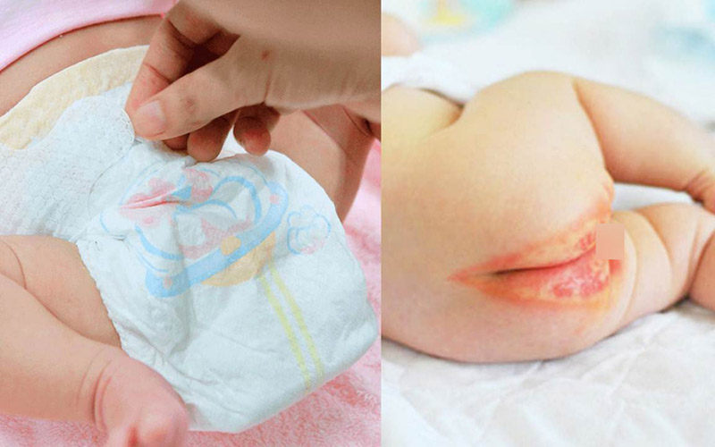 Bệnh viêm da mủ ở trẻ sơ sinh thường có xu hướng nghiêm trọng và nguy hiểm hơn các trường hợp ở người lớn.