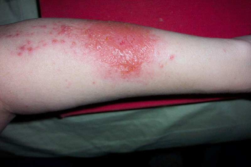 Viêm da tiếp xúc là tình trạng tổn thương gây ra khi tiếp xúc với các dị nguyên gây dị ứng.