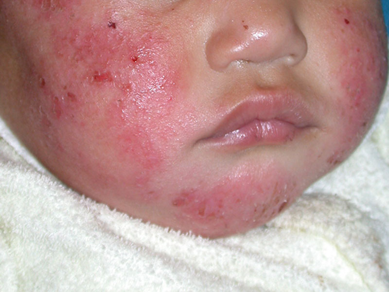 Nhiễm trùng, bội nhiễm vi khuẩn gây mụn mủ, mụn viêm có thể gặp ở những trẻ bị viêm da không được chăm sóc điều trị đúng cách