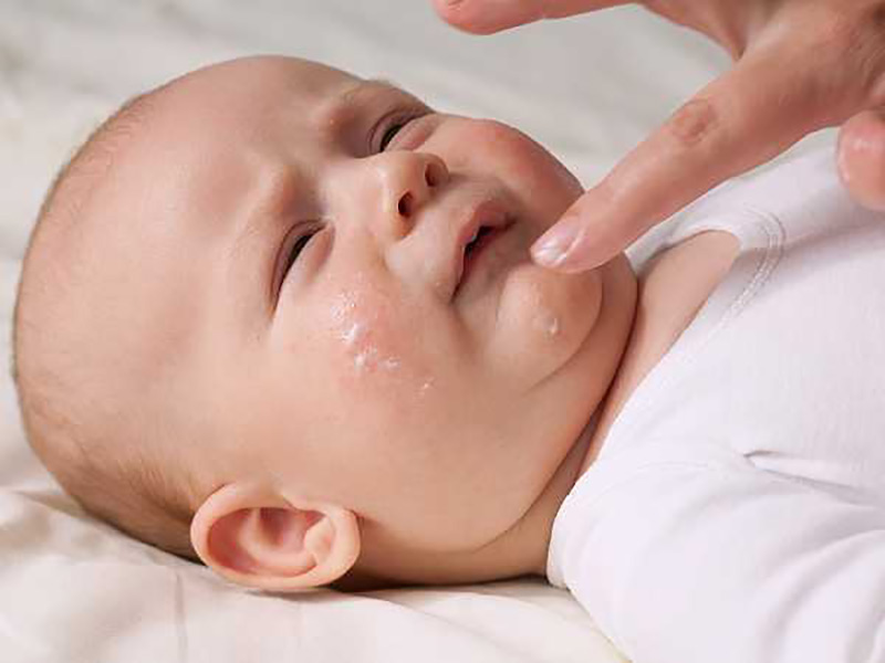 Điều trị viêm da tụ cầu ở trẻ nhỏ có thể áp dụng thuốc bôi ngoài da với tác dụng diệt khuẩn, giảm tình trạng viêm nhiễm