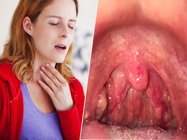 Viêm họng hạt có mủ - Những biến chứng nguy hiểm, triệu chứng và cách điều trị