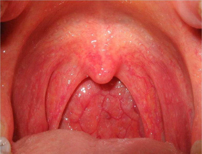 Niêm mạc họng phù nề, rát, đỏ, đau là dấu hiệu điển hình của bệnh viêm họng xung huyết