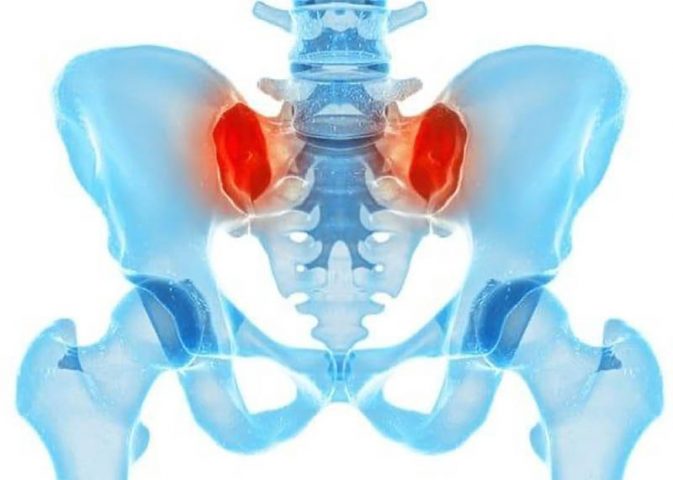 Viêm khớp cùng chậu là tình trạng viêm sưng tại các khớp giữa xương cột sống với xương chậu