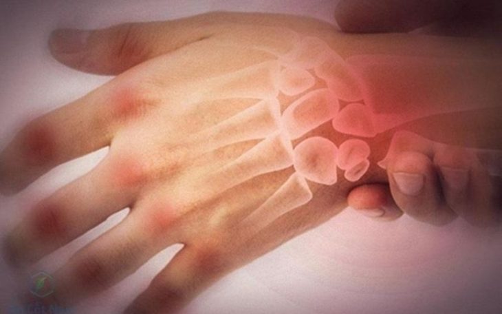 Viêm khớp tay: Nguyên nhân, biểu hiện và cách điều trị