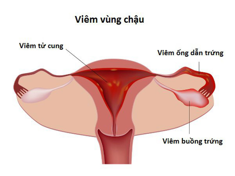 Viêm vùng chậu có thể ảnh hưởng đến toàn bộ buồng trứng, ống dẫn trứng