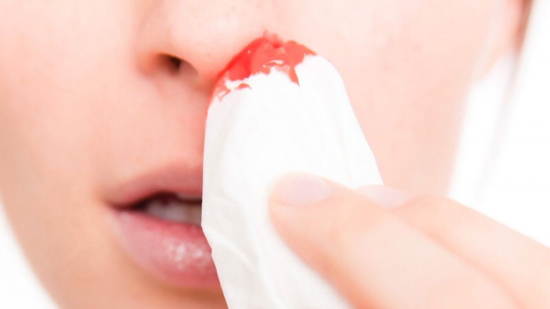 Nguyên nhân dẫn đến viêm xonag chảy máu mũi chủ yếu do lạm dụng thuốc xịt hoặc vệ sinh mạnh