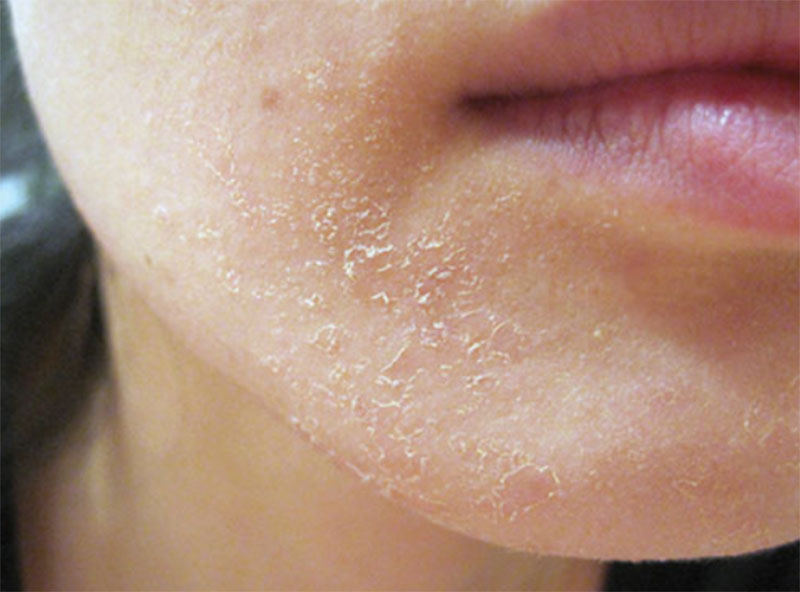 Chàm da mặt, vảy nến sẽ khiến da mặt bị ngứa, bong tróc và dễ nổi mụn