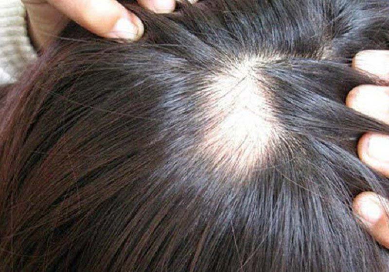 Sẹo sau rụng tóc có khiến người người bệnh cảm thấy ngứa, châm chích thường xuyên