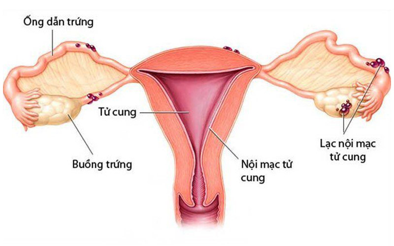 U lạc nội mạc tử cung là tình trạng các tế bào lạc nội mạc tử cung phát triển ở bên ngoài tử cung