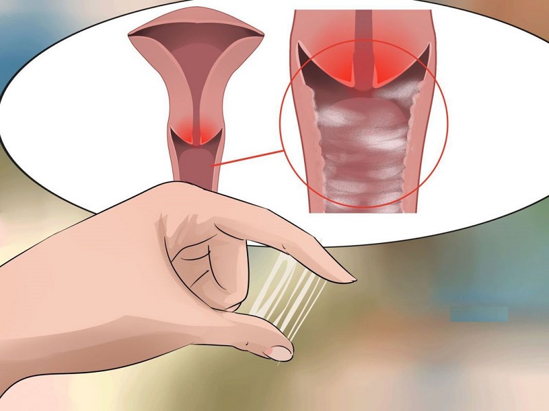 Chảy máu khi bị viêm âm đạo cần được chữa trị sớm