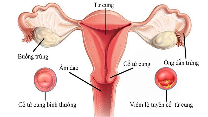 Viêm lộ tuyến cổ tử cung là nguyên nhân khiến âm đạo chảy mủ