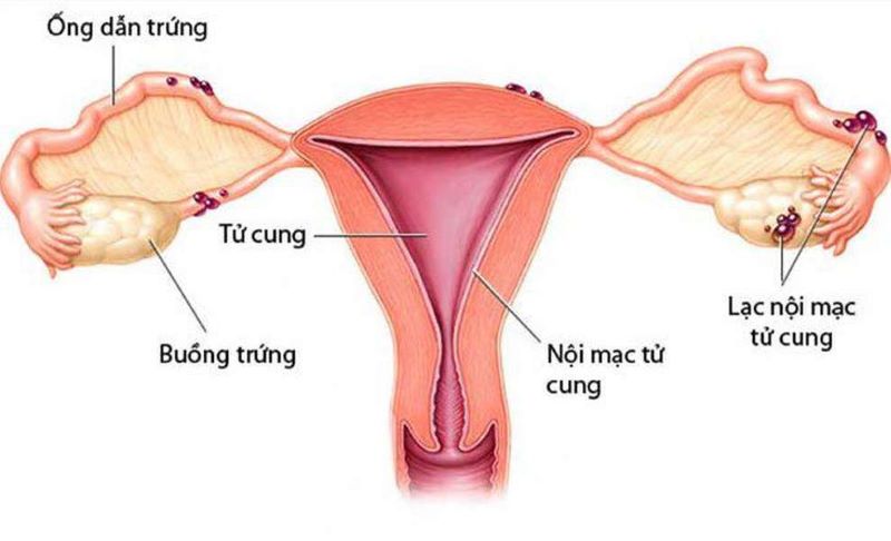 Nội mạc tử cung bị viêm nhiễm cũng có thể làm âm đạo chảy mủ