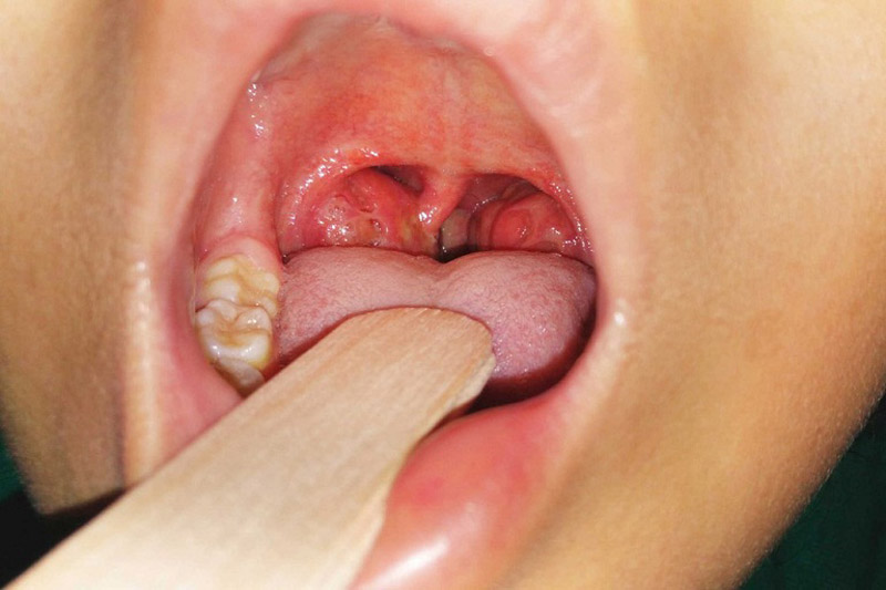 Viêm mũi họng xuất tiết là tình trạng bệnh nặng cần điều trị sớm