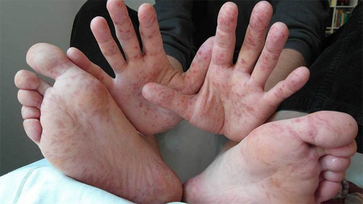Ngứa chân, tay là triệu chứng ngoài da thường gặp