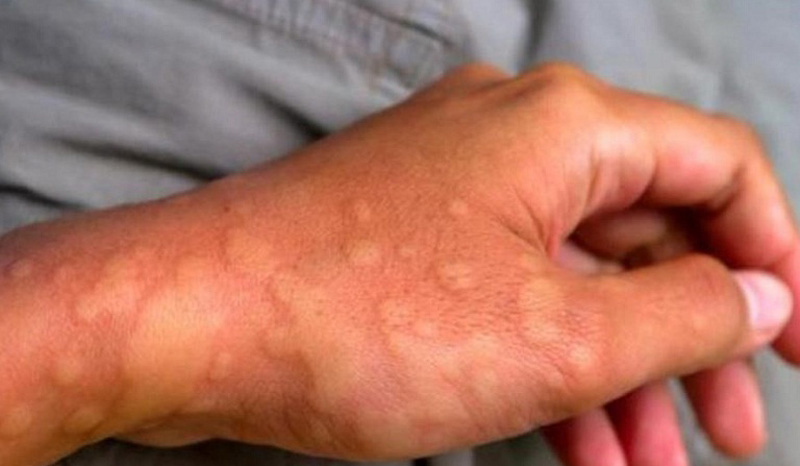 Mề đay là nguyên nhân phổ biến gây tình trạng mẩn ngứa ngoài da