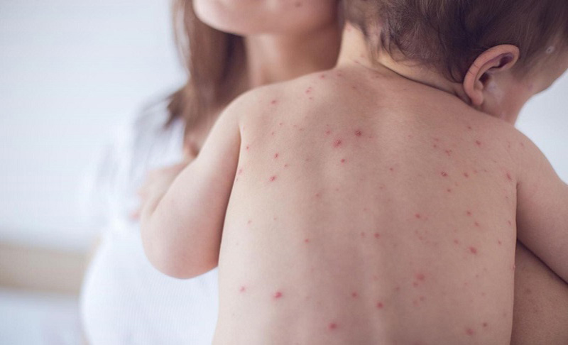 Nổi mề đay ở lưng của trẻ em có thể gây ảnh hưởng lớn đến sức khỏe và thẩm mỹ làn da của bé