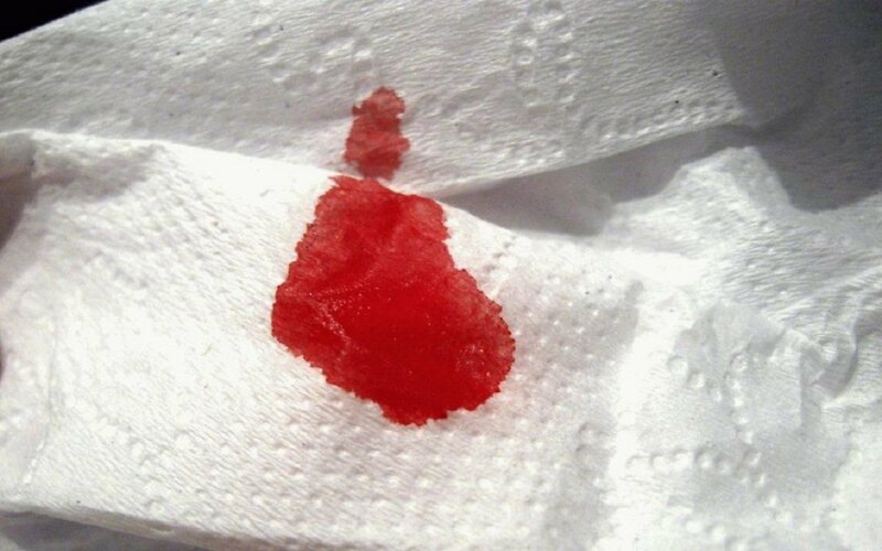 Tiểu buốt ra máu ở nữ giới là tình trạng trong nước tiểu có máu