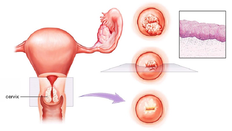 viêm lộ tuyến tái tạo cổ tử cung là gì