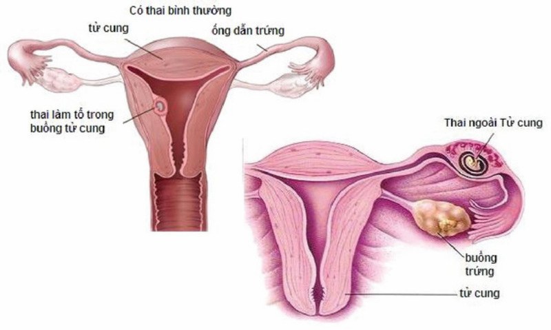 Đau bên trái có thể là dấu hiệu mang thai ngoài tử cung ở phụ nữ