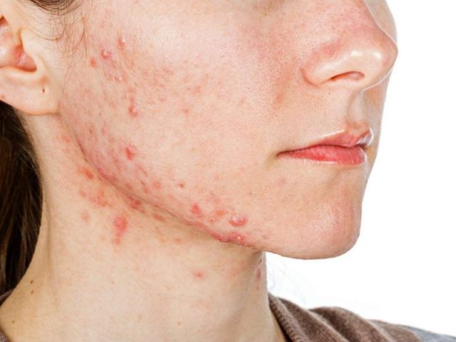 Dị ứng mỹ phẩm là tình trạng da mặt bị tổn thương tạo nên những nốt mẩn đỏ, nổi mụn, ngứa, nóng rát