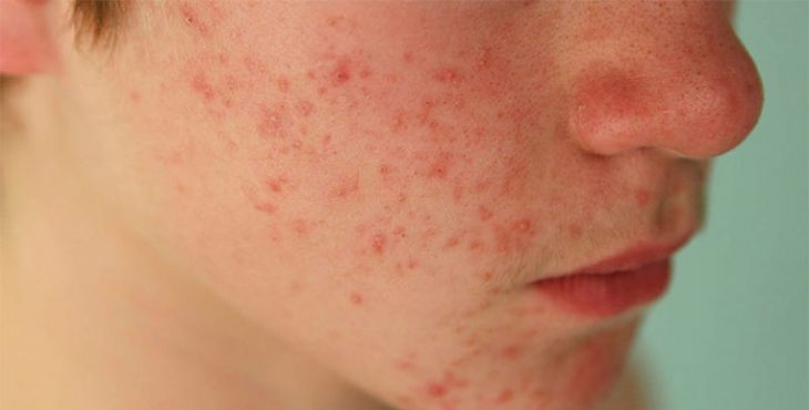 Da mặt nổi mẩn đỏ sẽ ảnh hưởng nhiều đến tâm lý và sức khỏe của người bệnh