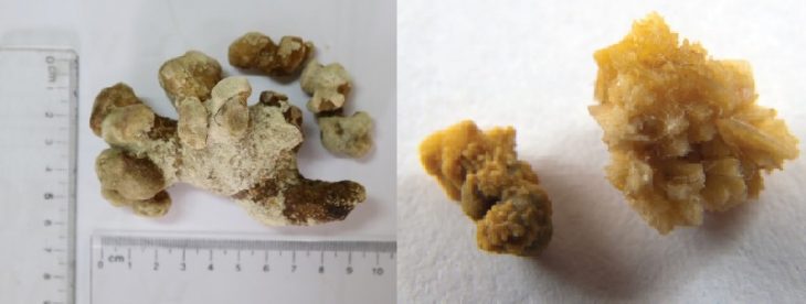 Một số hình dạng của loại sỏi thận san hô