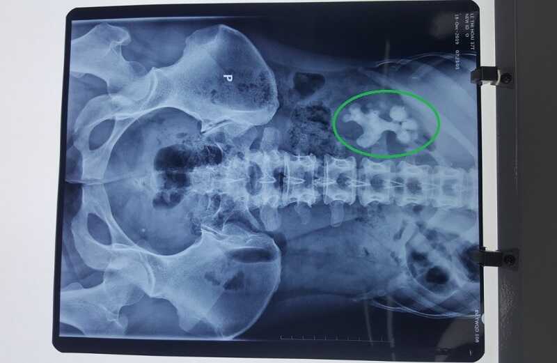 Hình ảnh chụp X - quang của một bệnh nhân bị sỏi san hô
