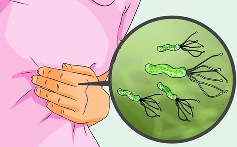 Hiện nay trong y học có rất nhiều cách tiêu diệt vi khuẩn Hp gây đau dạ dày tận gốc an toàn và hiệu quả