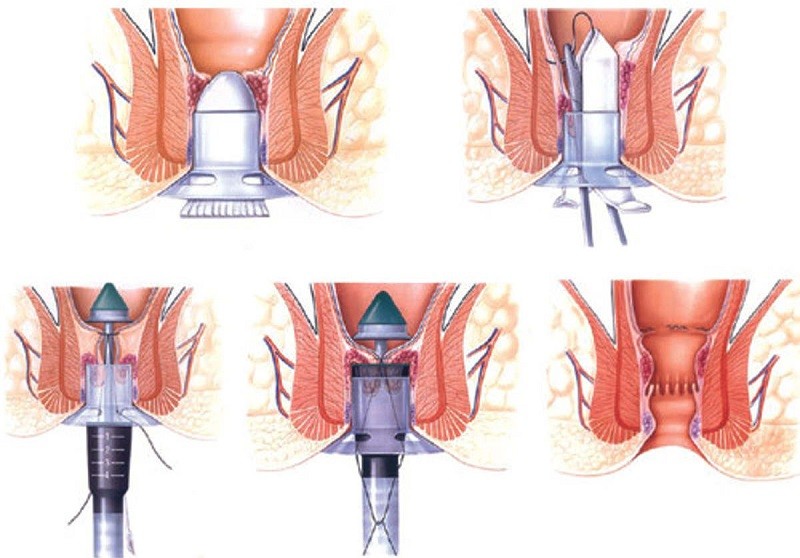 Các kỹ thuật phẫu thuật cũng thường được chỉ định đối với bệnh nhân trĩ nội đã xuất hiện biến chứng nguy hiểm.