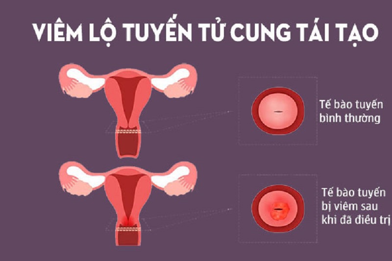 Viêm tái tạo cổ tử cung là biến chứng xuất hiện trong quá trình phục hồi lộ tuyến cổ tử cung