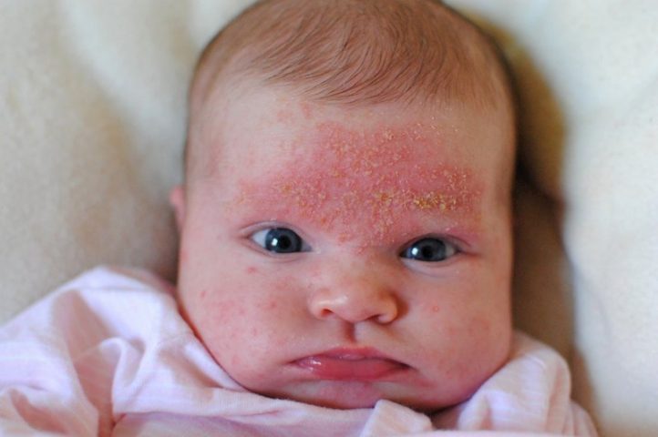 Phù nề, mẩn ngứa, da đóng vảy là các triệu chứng dễ nhận biết nhất khi bé bị bệnh