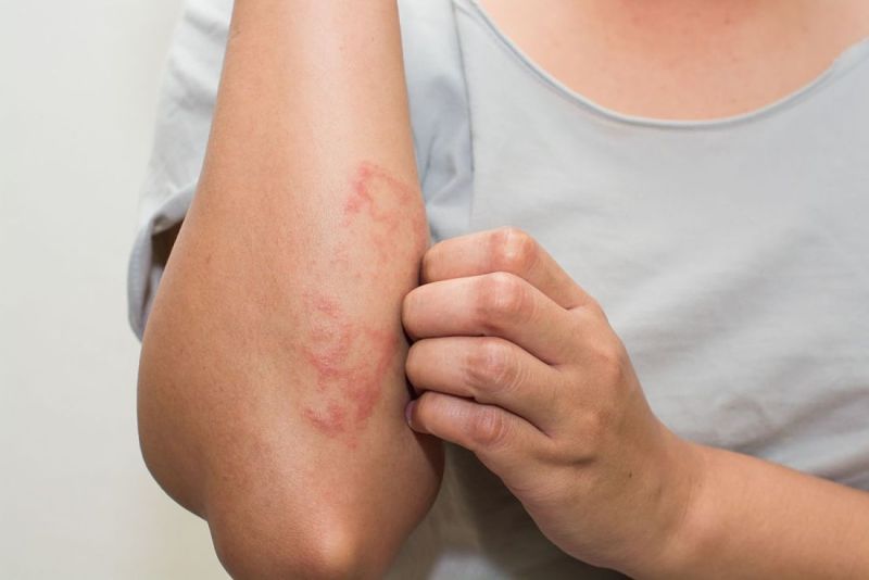 Bệnh Eczema Là Gì? Triệu Chứng Nhận Biết Và Cách Điều Trị