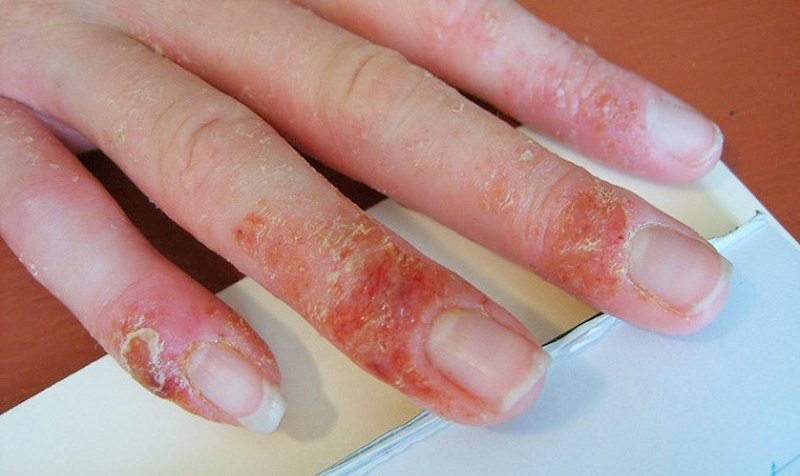 Hình ảnh bệnh chàm khô ở đầu ngón tay