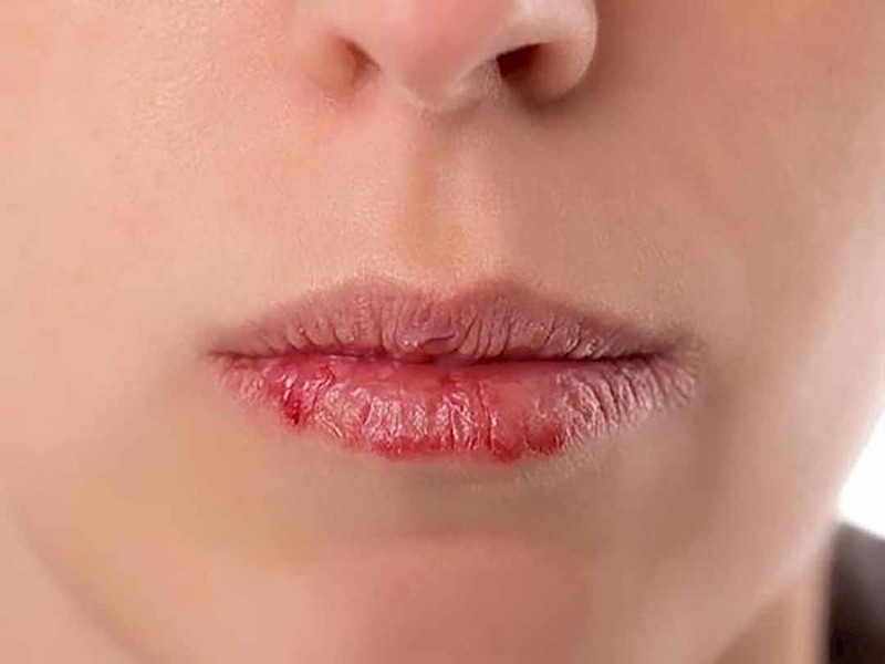 Bệnh chàm môi có thể gặp ở bất kỳ đối tượng nào