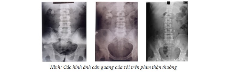 Hình ảnh kết quả của phương pháp chụp X-quang có thuốc cản quang