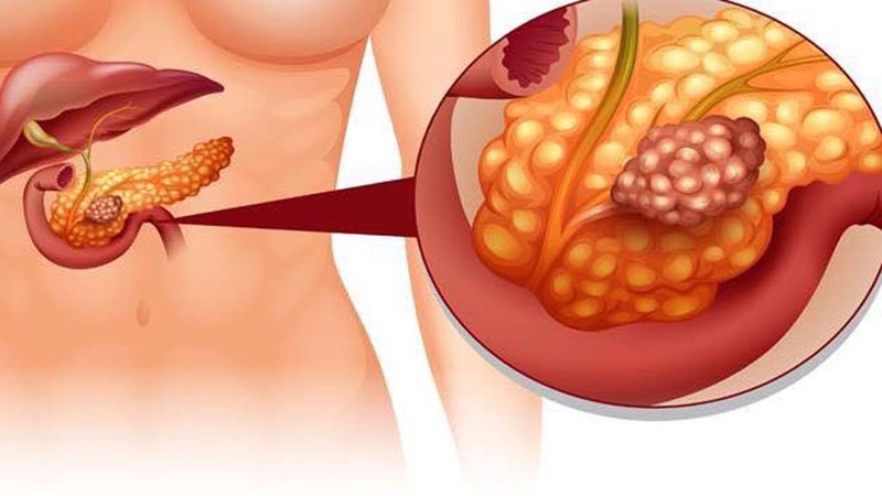 Đau tức vùng ngực bên phải cũng là triệu chứng của bệnh viêm tụy