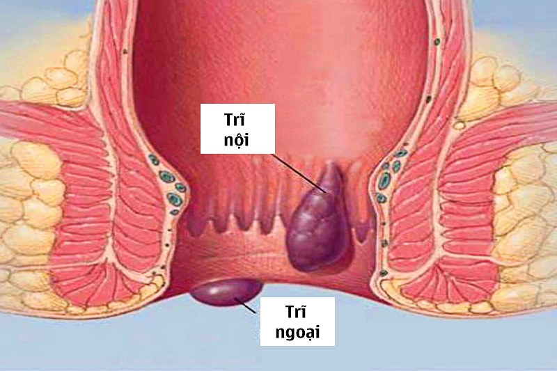 Bệnh được chia thành 2 dạng chính là trĩ nội tắc mạch và trĩ ngoại tắc mạch.