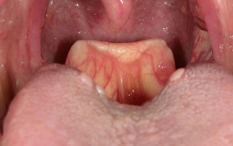Viêm nhiễm trong khoang miệng khiến lưỡi có màu trắng