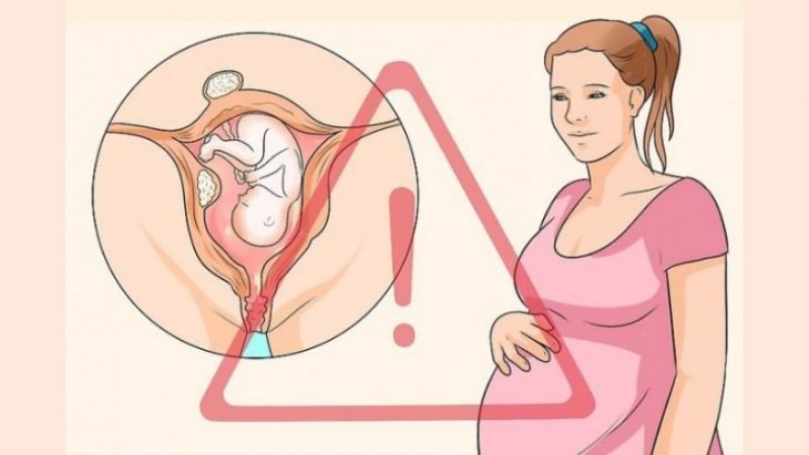 U xơ tử cung có thể mang thai được không