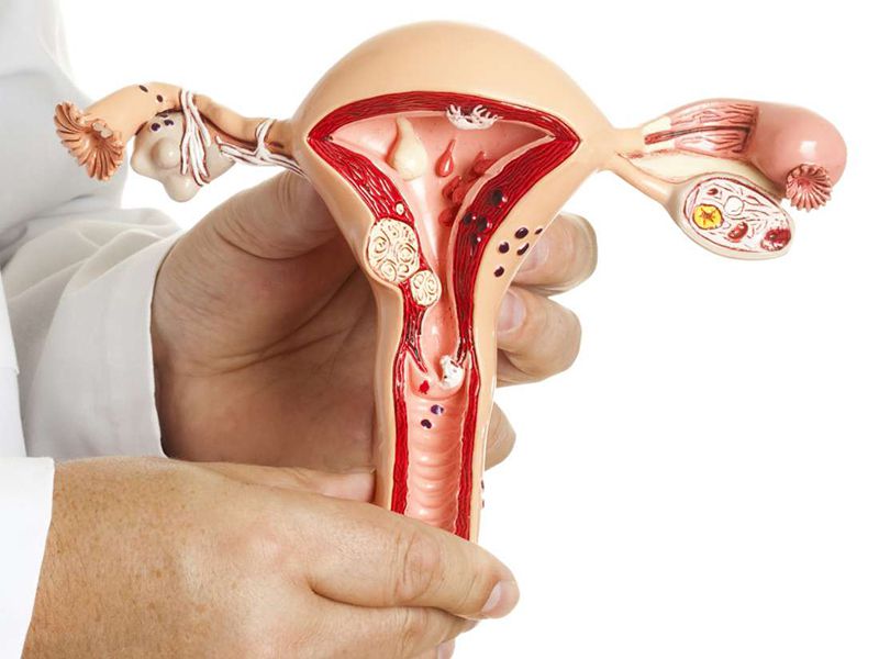 U xơ tử cung lành tính có xu hướng tự teo, có thể tự hết khi nữ giới mãn kinh
