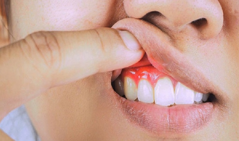 Viêm nha chu là một trong những biến chứng tại răng miệng ở người bị tiểu đường