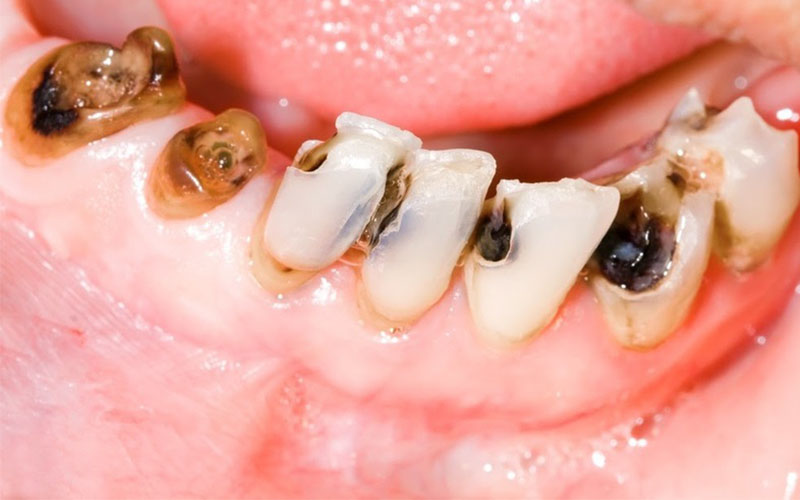 Y học hiện đại đã nghiên cứu và chỉ ra dược liệu có tác dụng trong điều trị sâu răng