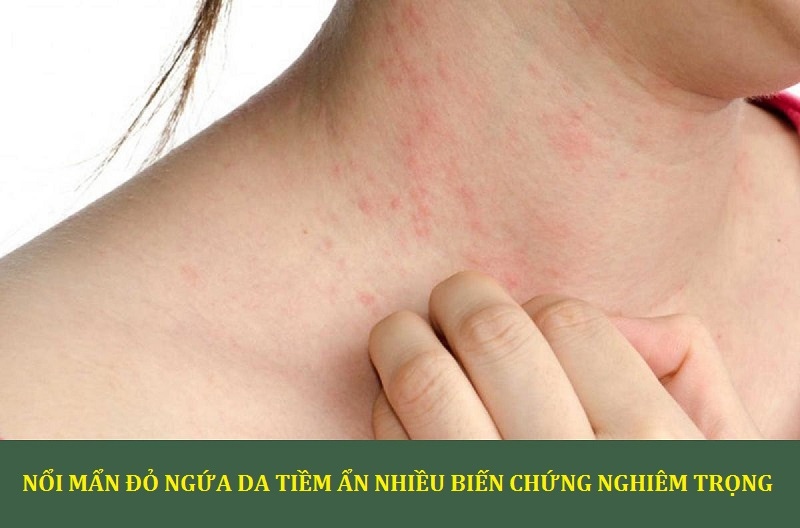 Chuyên gia khuyến cáo: Người bệnh không nên chủ quan khi bị nổi mẩn đỏ trên da