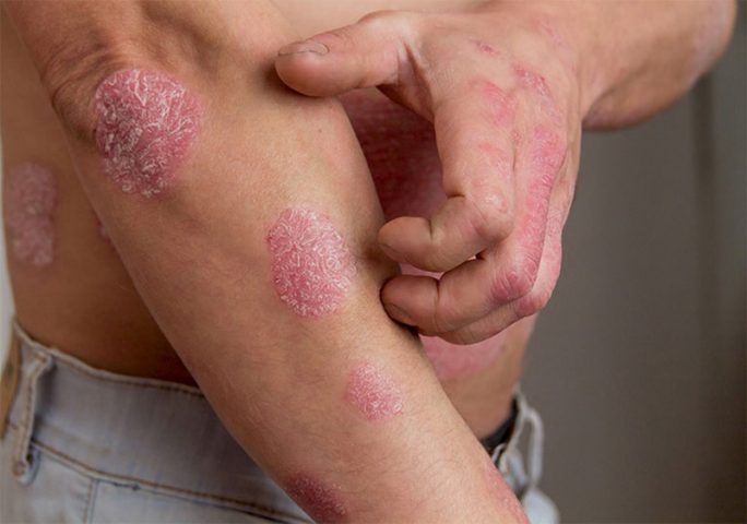 Các tổn thương vảy nến thường có xu hướng khu trú tại một vùng da nhất định