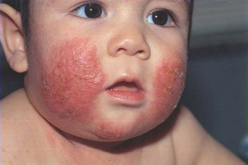 Trẻ bị chàm da thường gặp triệu chứng nổi ban đỏ, da khô, ngứa, bong tróc
